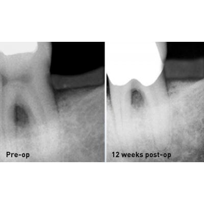 FONALaser Стоматологический лазер FONA Dental