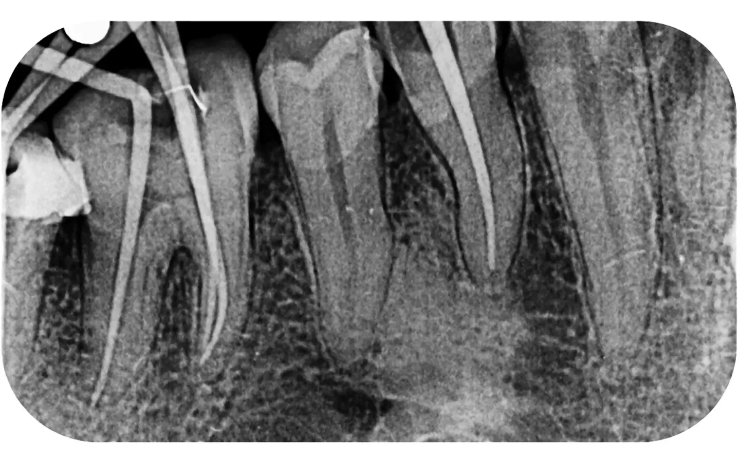 Высокое пространственное разрешение визиографа DTE Woodpecker