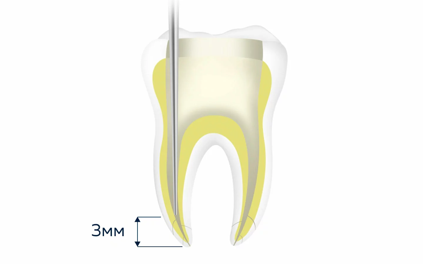 Инъекционная игла 0.5 мм Fi-G