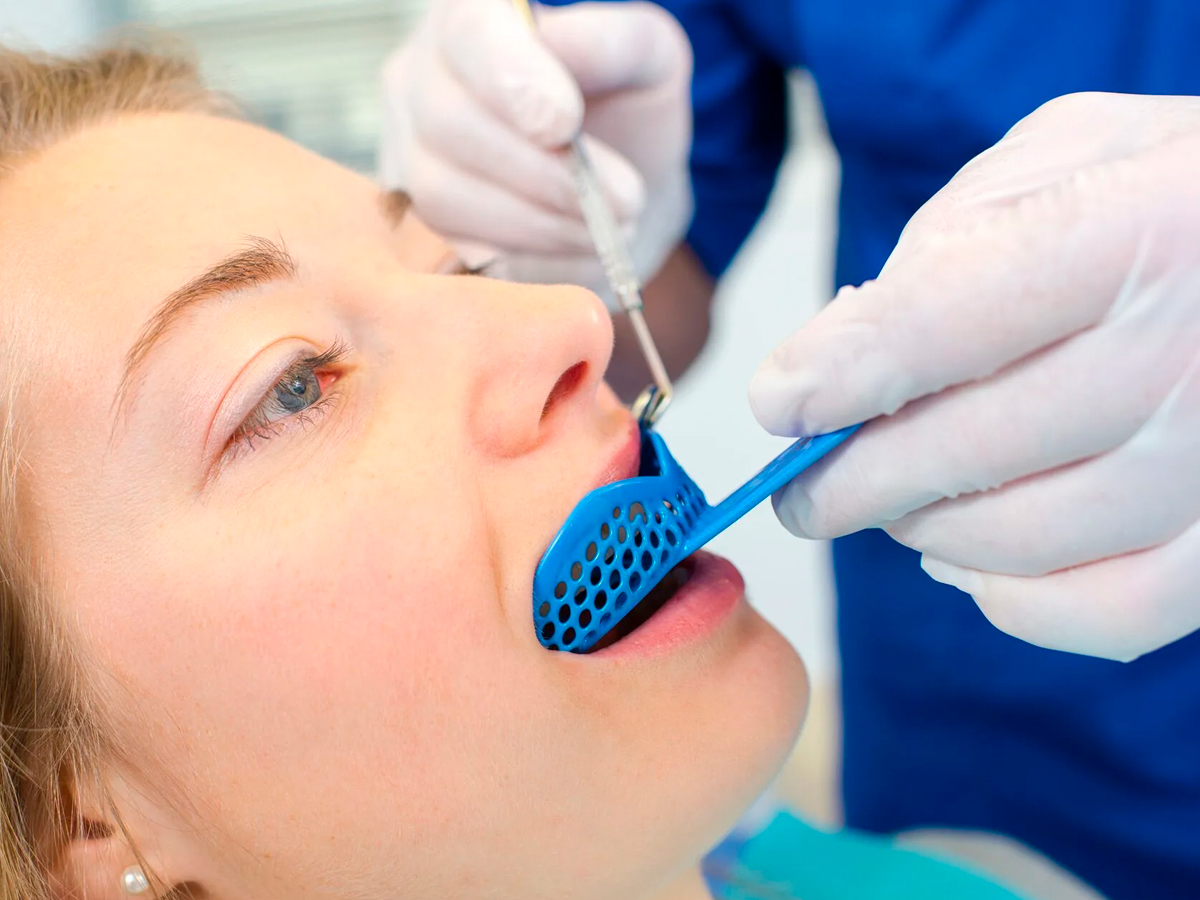 Процесс получения традиционного слепка зубов альгинатной или силиконовой массой