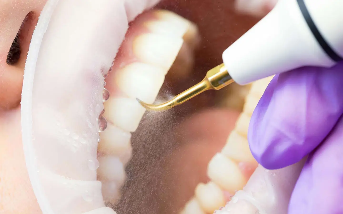 Клиническое применение скалера DTE-D5 LED