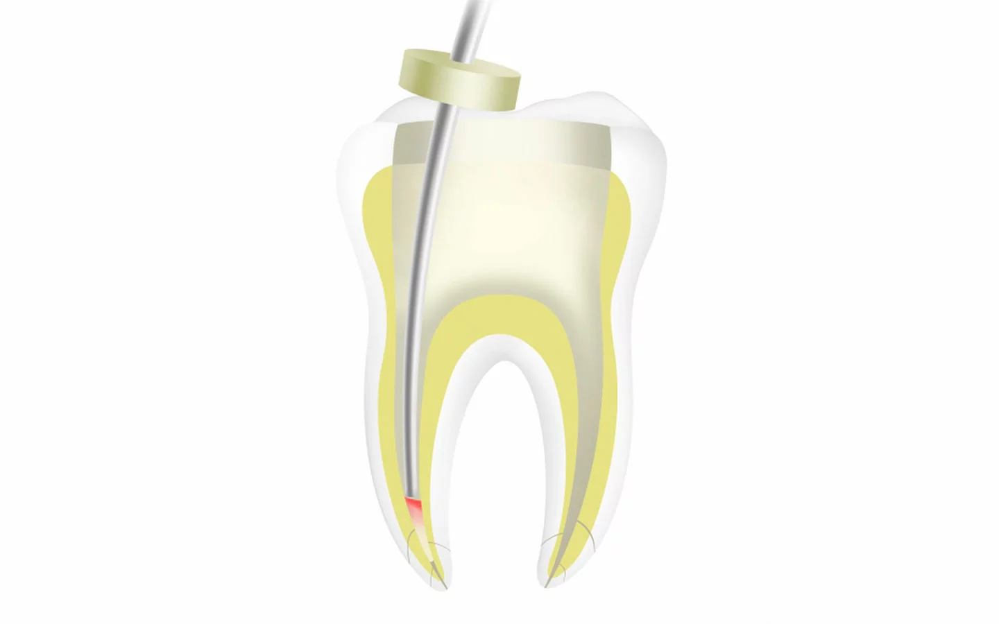 Ультратонкий плаггер 0.35 мм