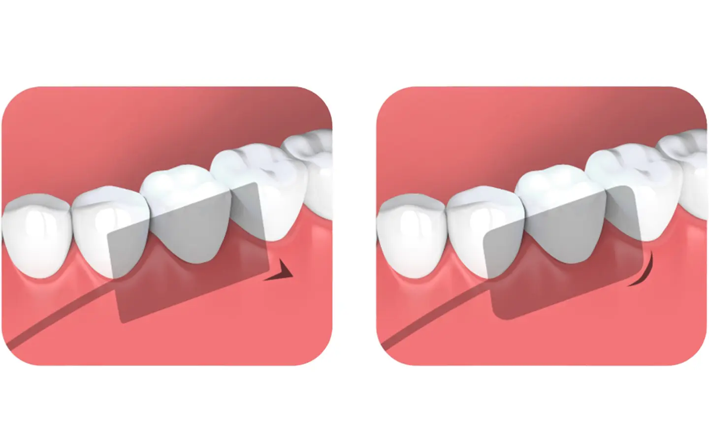Диагностические снимки на радиовизиографе DTE i-Sensor