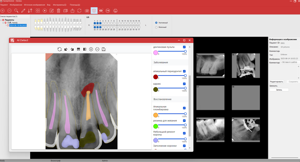 Анализ рентгеновского снимка с помощью Искусственного Интеллекта