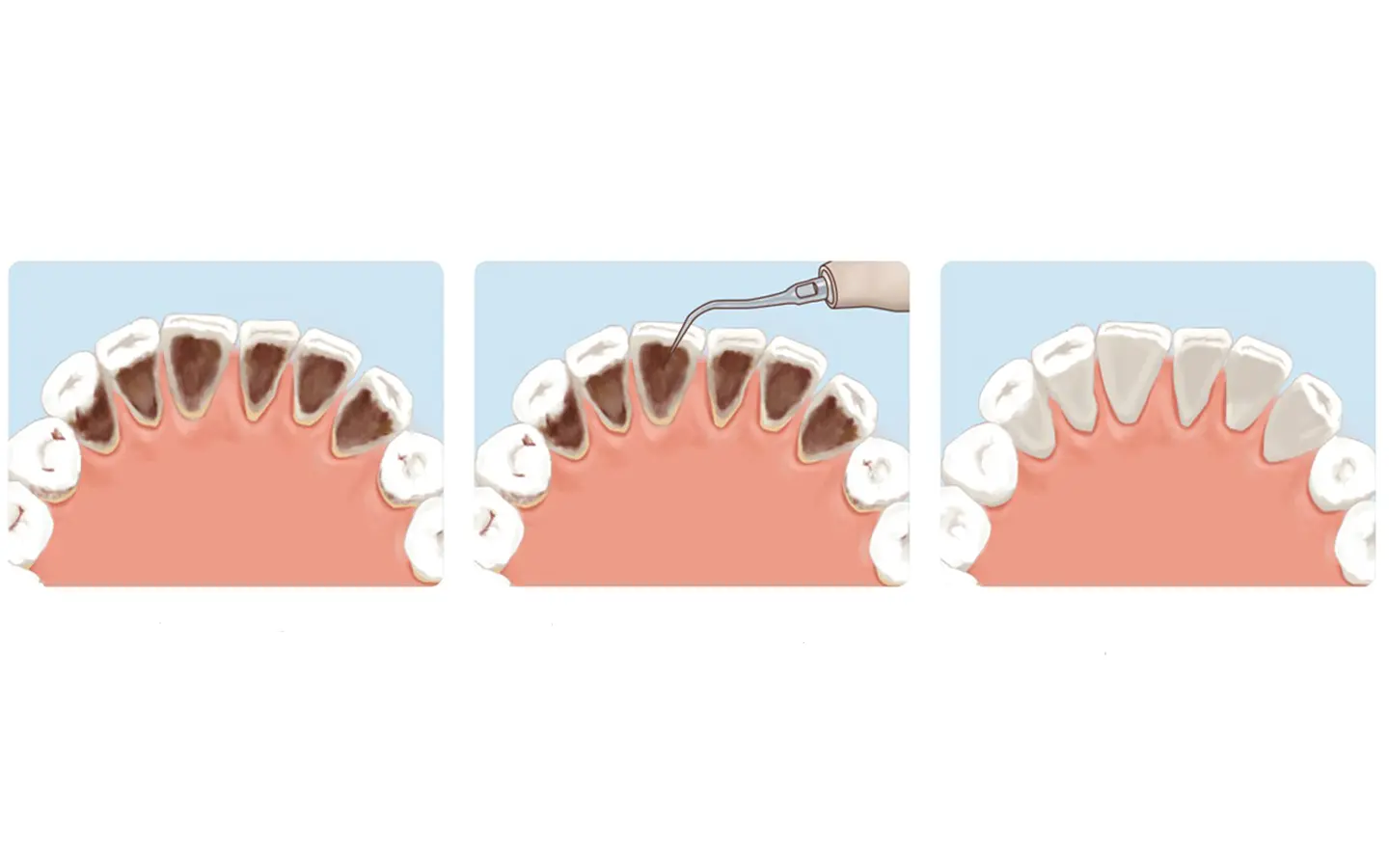 Титановые ультразвуковые насадки Woodpecker PT5