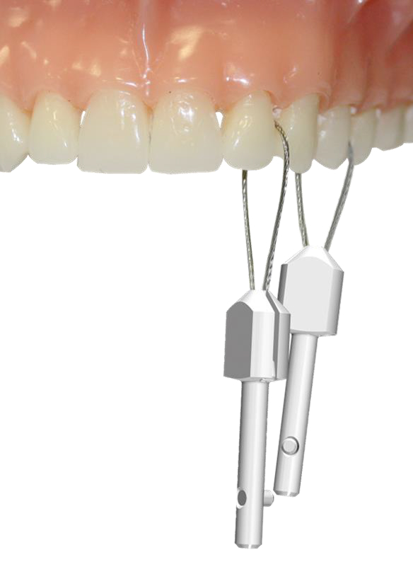 Использование струн 50 мм и 60 мм для снятия коронок