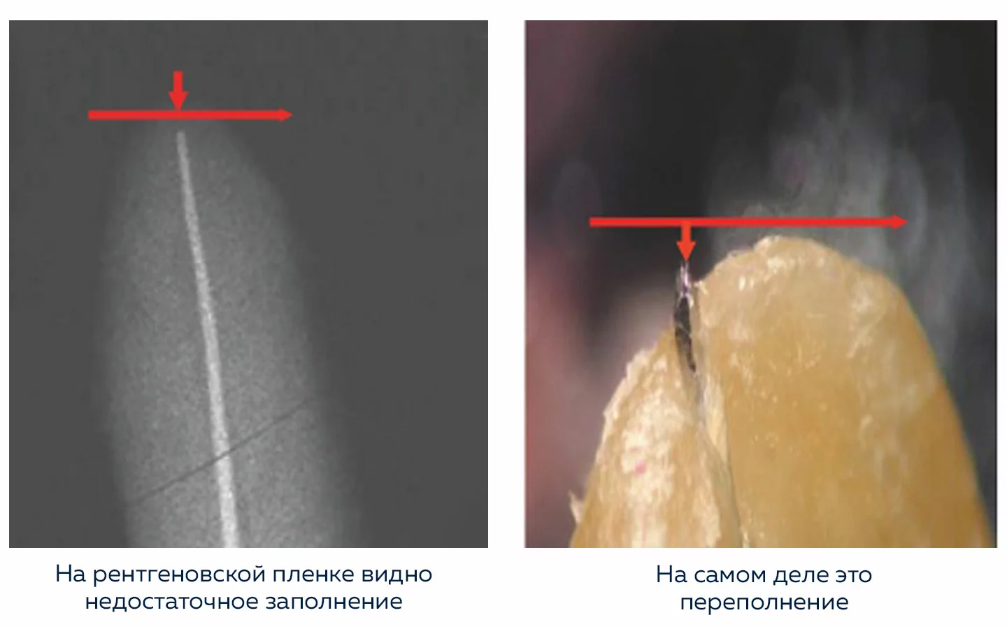 Сравнение апекслокатора DPEX 3 и рентгеновского снимка