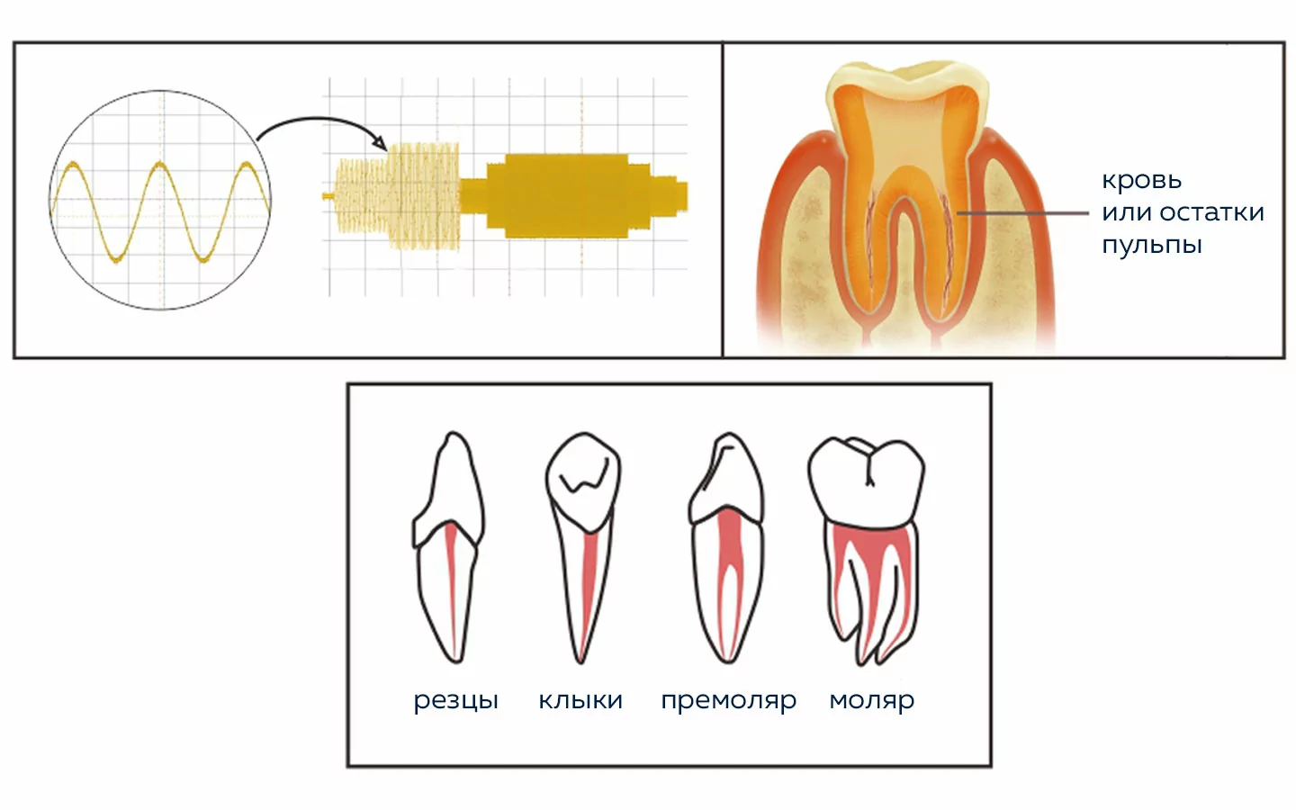 Мультичастотная технология апекслокатора DTE