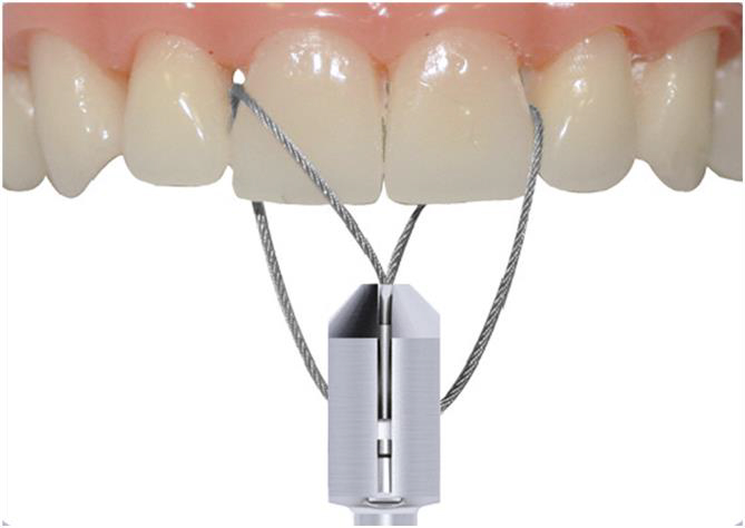 Снятие мостовидных протезов струнами 95 мм и 150 мм Anthogyr