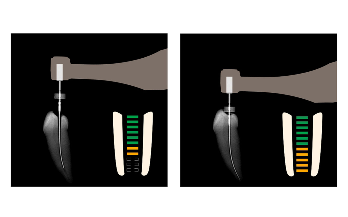 Эндомотор и апекслокатор совместный режим на дисплее