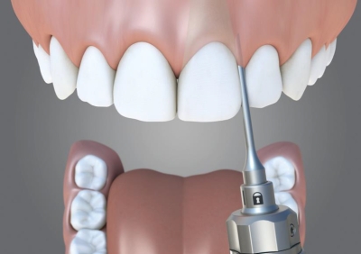 Набор периотомов Exo Safe включая наконечник Safe impactor Anthogyr (Франция)  EXO_FULL