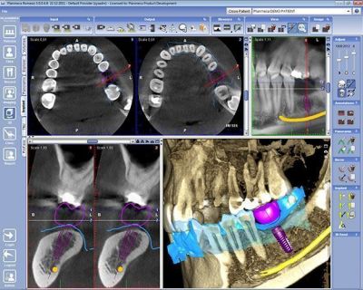 Planmeca CAD/CAM система для врача PLANMECA OY (Финляндия)