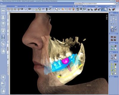 Planmeca CAD/CAM система для врача PLANMECA OY (Финляндия)