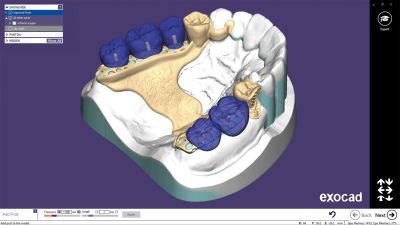 Exocad Partial Framework Module Модуль создания бюгелей Exocad