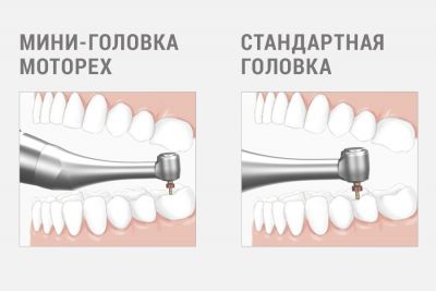 DTE MotoPex Эндомотор с апекслокатором Woodpecker (Китай)