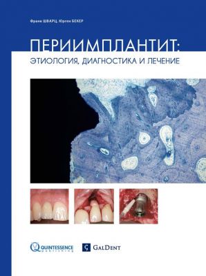 Шварц Ф. Бекер Ю. Периимплантит: этиология, диагностика и лечение. Стом. издания