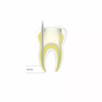 Обтуратор гуттаперчи Fi-G (Инжектор) Woodpecker (Китай)  Fi-G
